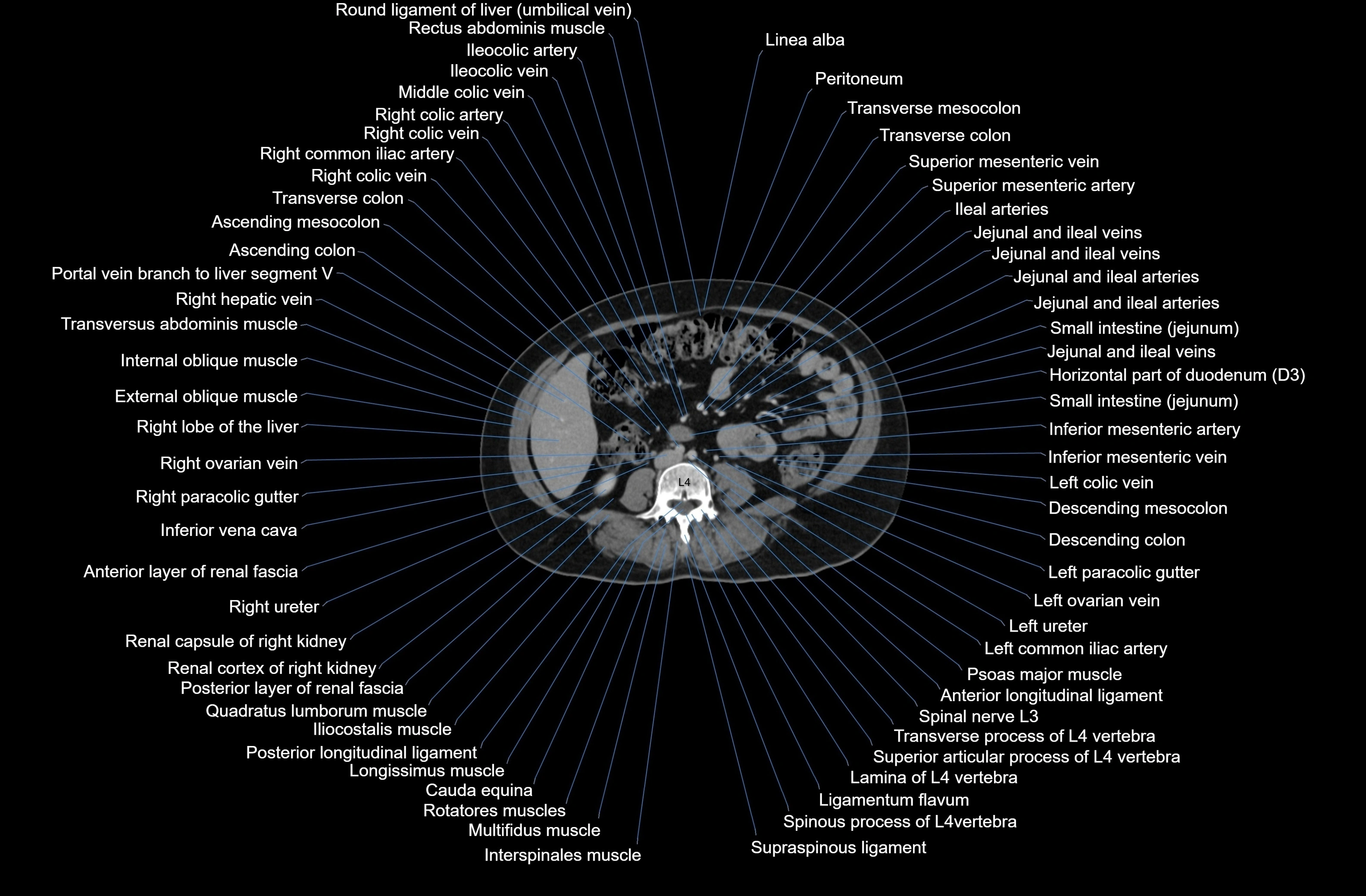 CT Abdomen axial cross sectional anatomy labelled radiology image-00051.webp
